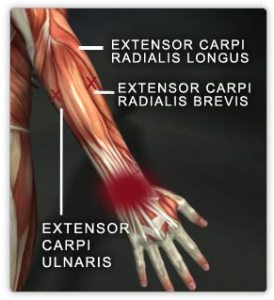 4fde4a7ae4b0f2662fd349f8-agentx5-1340024160396-hand_extensors